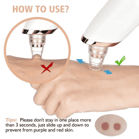 Rechargeable 5 in 1 Blackhead Remover Vacuum